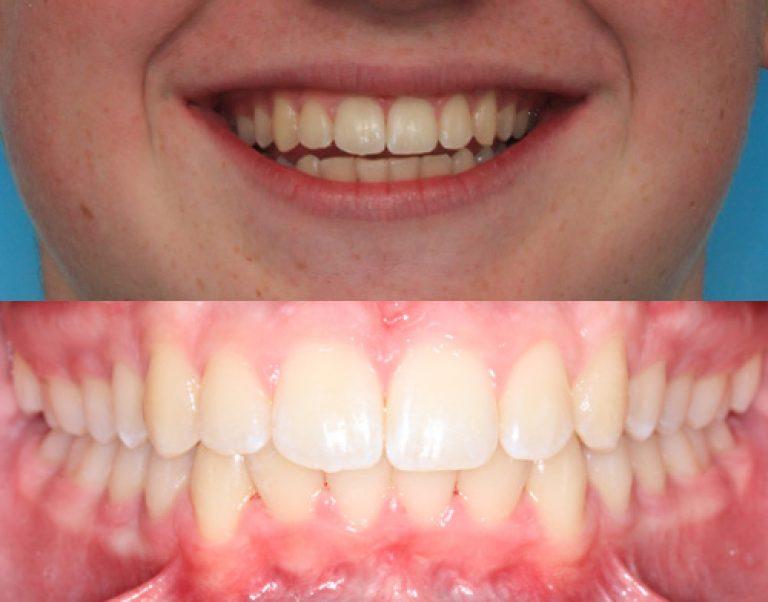 Invisalign in Auckland results 3