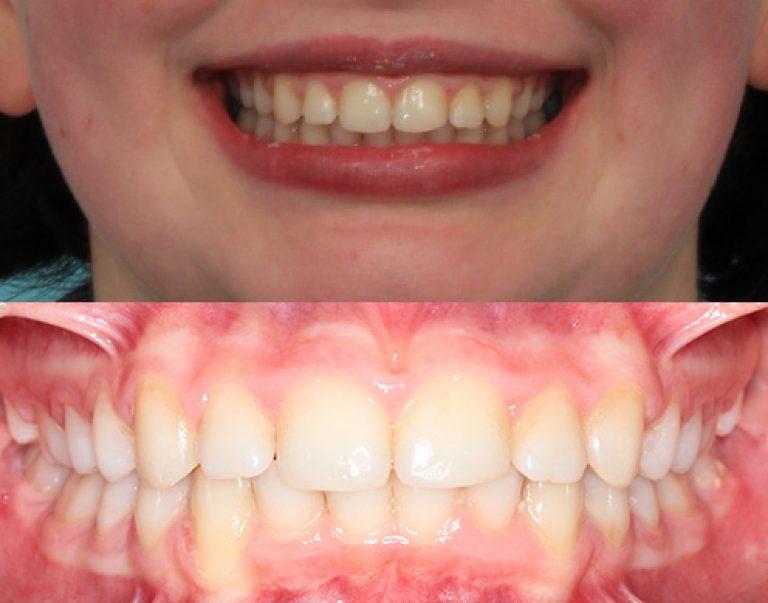 Invisalign in Auckland results 8