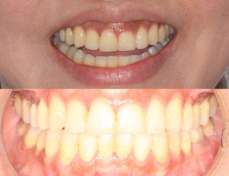 Invisalign in Auckland results 1