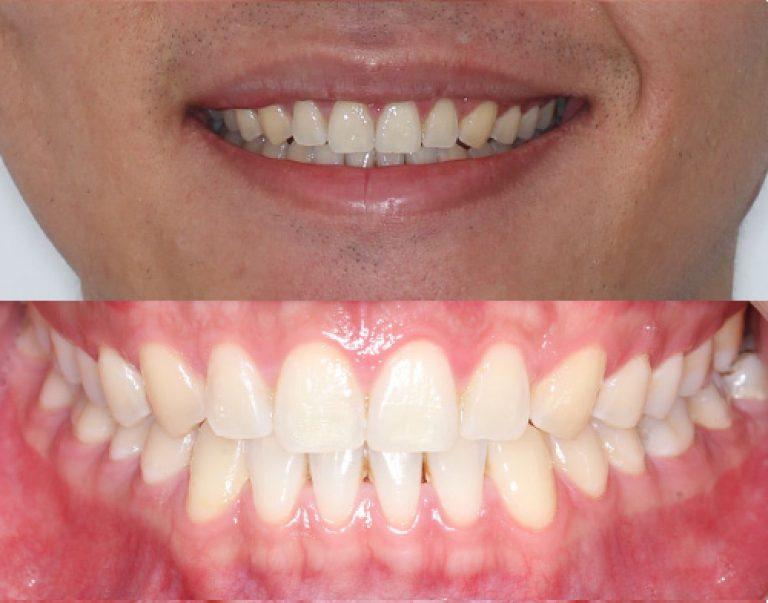 Invisalign in Auckland results 4