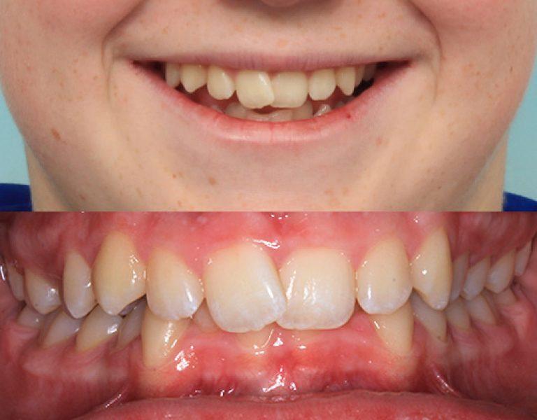 Invisalign in Auckland results 5