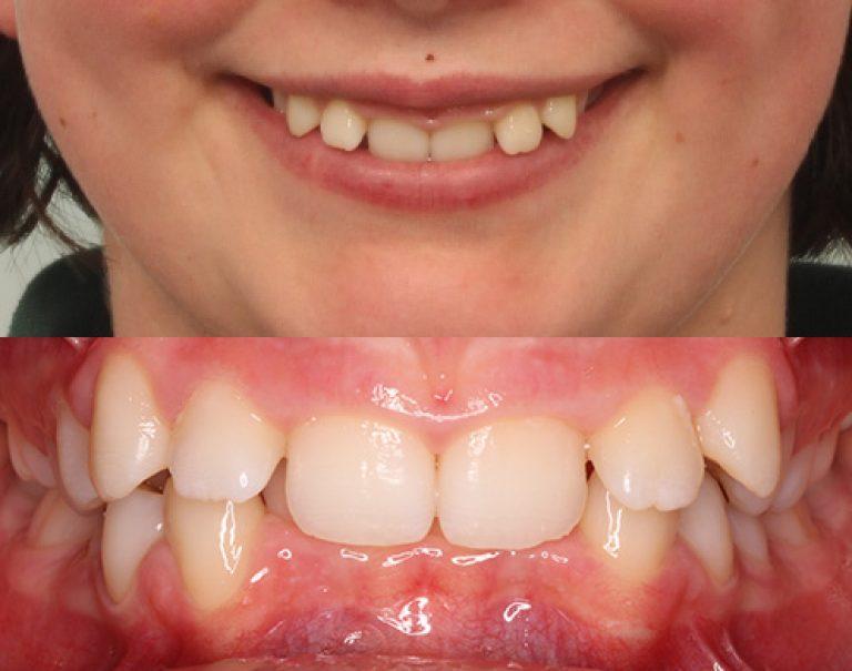 Invisalign in Auckland results 9